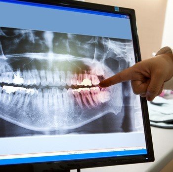 Preventative Dentistry
