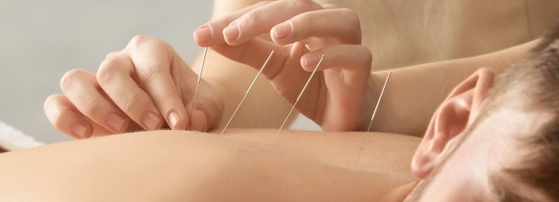 Acupuncture session at Balsam Clinic