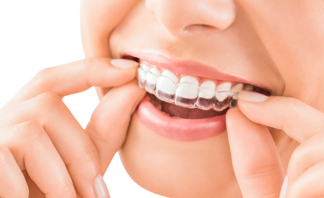 Clear Aligners at NorthView Dental, London ON