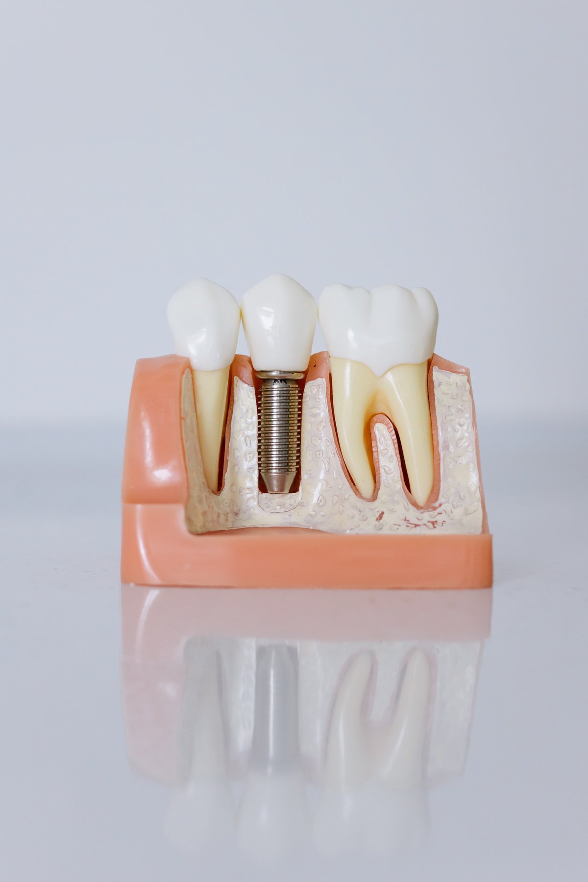 Dental implant model at NorthView Dental, London ON